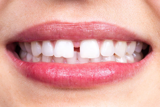 gap-in-teeth-elite-dental-group