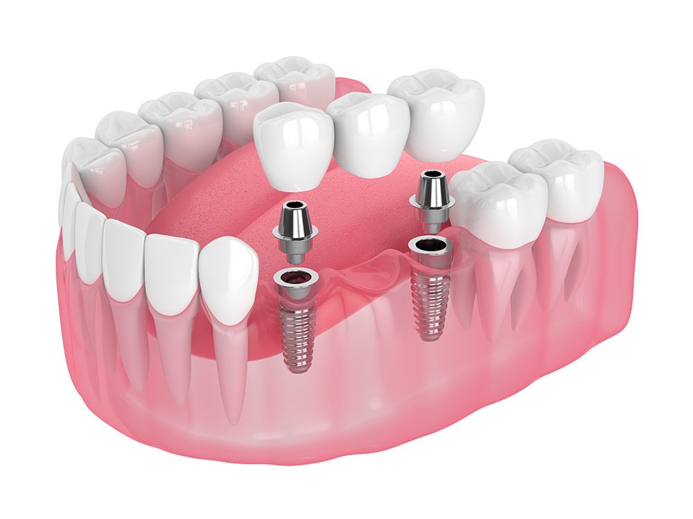 dental-implant-elite-dental-group