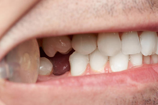 missing-teeth-elite-dental-group